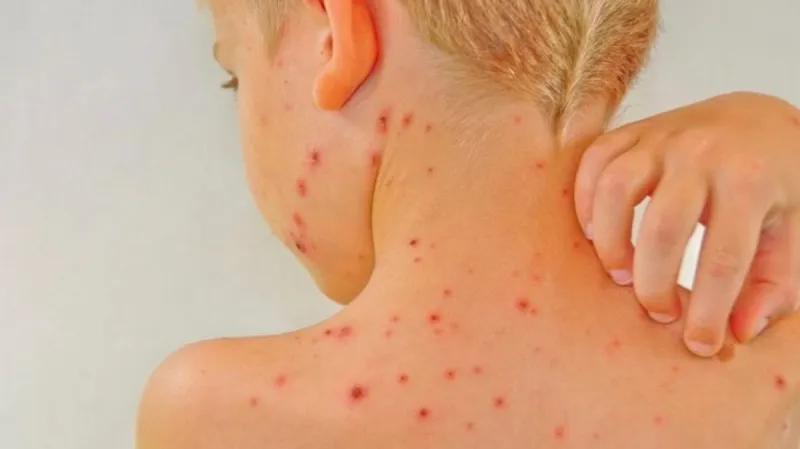 Među školarcima u ZHŽ-u pojavile se vodene kozice